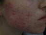 Acne Scars with Laser Resurfacing
