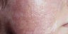 Acne Scars with Laser Resurfacing