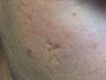 Acne scars treated with Punch Elevation of scars and Fractional Laser Resurfacing