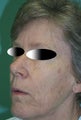 Full face laser resurfacing