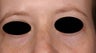 Blue veins around eyes