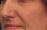 Laser Vein Treatment