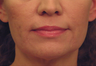 Yag Laser Skin Tightening