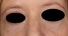 Blue veins around eyes