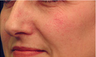 Laser Vein Treatment