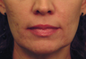 Yag Laser Skin Tightening