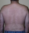 Laser Hair Removal