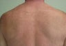 Laser Hair Removal for Back