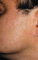 Laser Hair Removal on Face