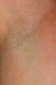 Laser hair removal for armpits