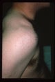Laser hair removal