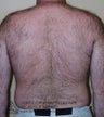 Laser Hair Removal