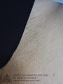 Laser Hair Removal to Bikini Area