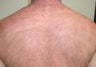 Laser Hair Removal for Back