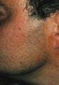 Laser Hair Removal on Face