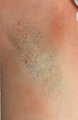 Laser hair removal for armpits