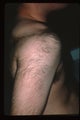 Laser hair removal