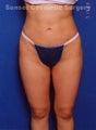 Liposuction