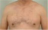 Smart Lipo of the chest