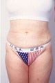 Liposuction