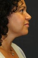 Neck Liposuction utilizing Laser Liposuction
