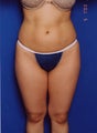 Liposuction