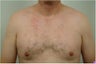 Smart Lipo of the chest