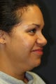 Neck Liposuction utilizing Laser Liposuction