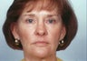 Laser Skin Resurfacing