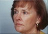 Laser Resurfacing