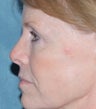 Laser resurfacing