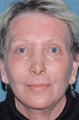 Laser resurfacing treatment for wrinkles