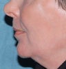 Laser resurfacing for mouth