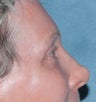 Laser resurfacing around eyes