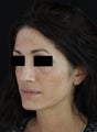 Laser Skin Resurfacing
