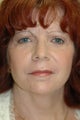 Laser skin resurfacing, eyelid surgery, lip augmentation
