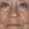 Laser Resurfacing