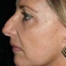 Laser Resurfacing