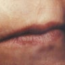Laser Resurfacing