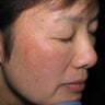 Laser Resurfacing