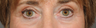 Laser Skin Resurfacing