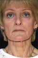 Laser Resurfacing