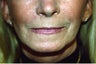 Laser Skin Resurfacing with Dr. Clevens