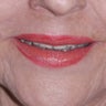 Laser Resurfacing