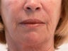 Laser resurfacing