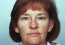 Laser Skin Resurfacing