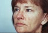 Laser Resurfacing
