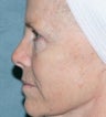 Laser resurfacing