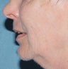 Laser resurfacing for mouth