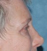 Laser resurfacing around eyes